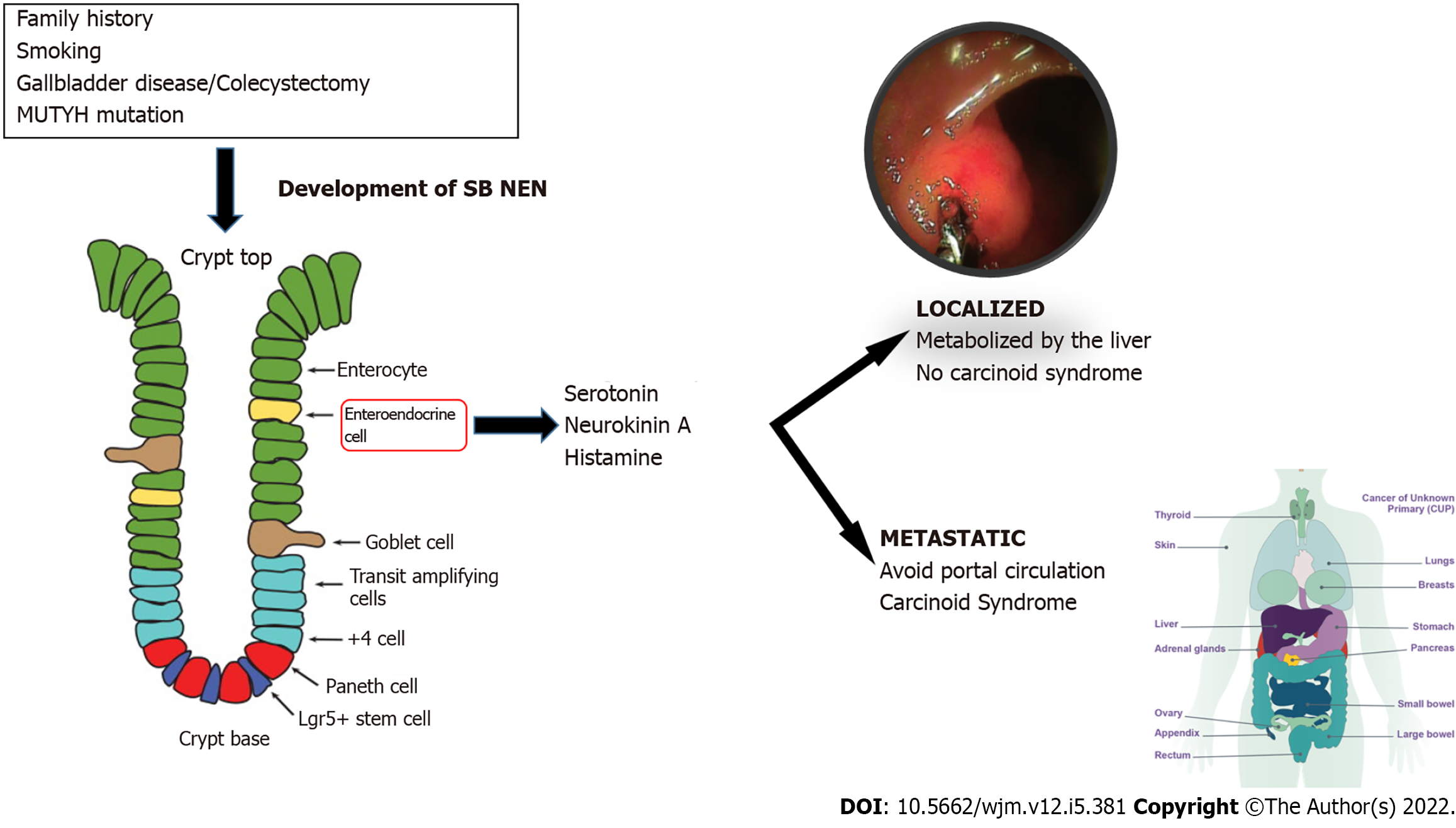 Small Intestine Neoplasm