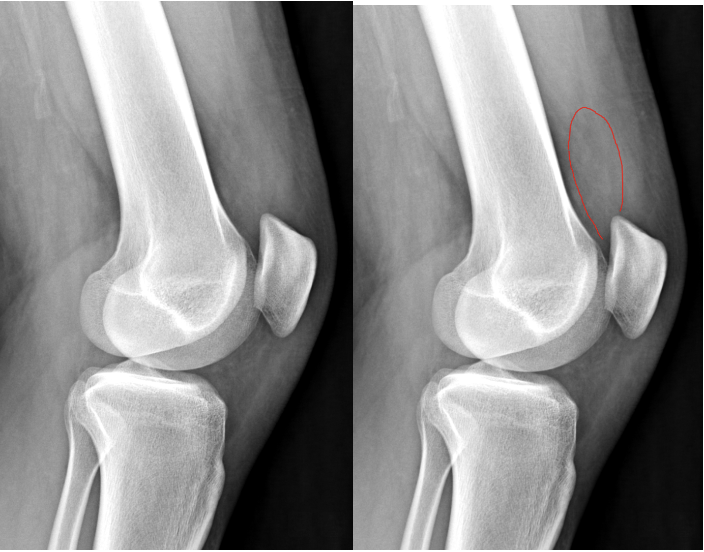Small Knee Effusion