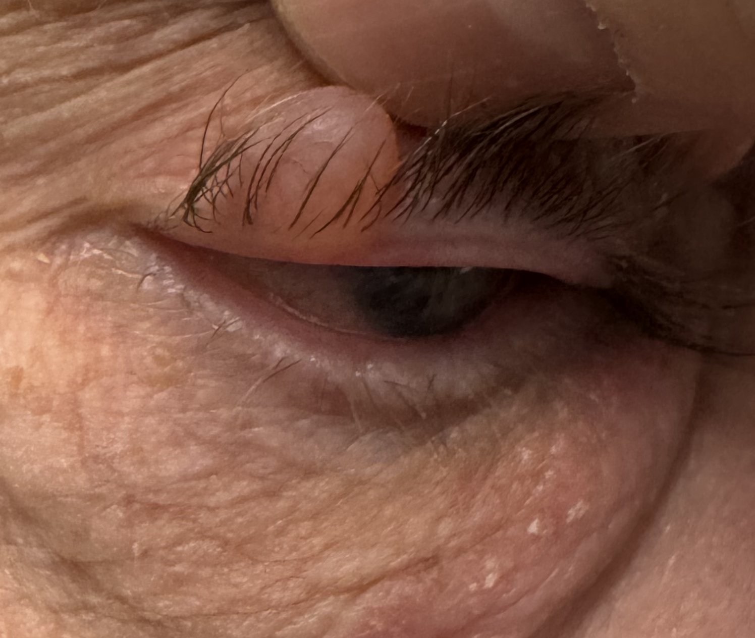 Small Lumps In Eyelid