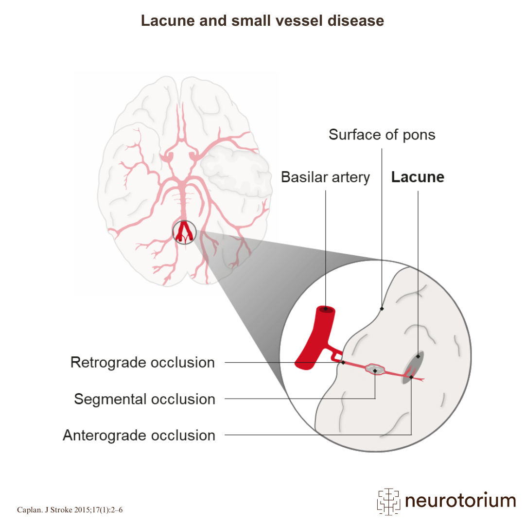 Small Vessel Disease