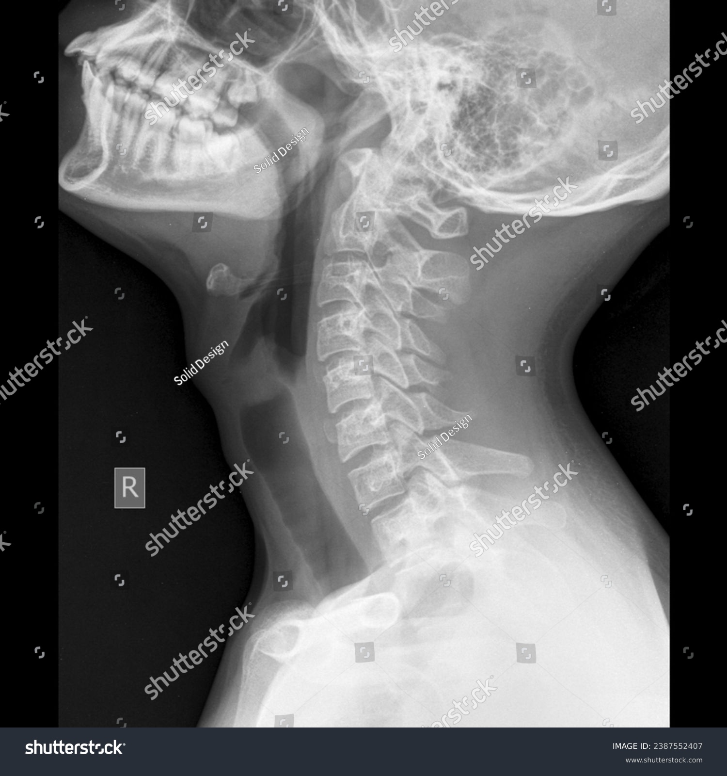 Soft Tissue Neck X Ray