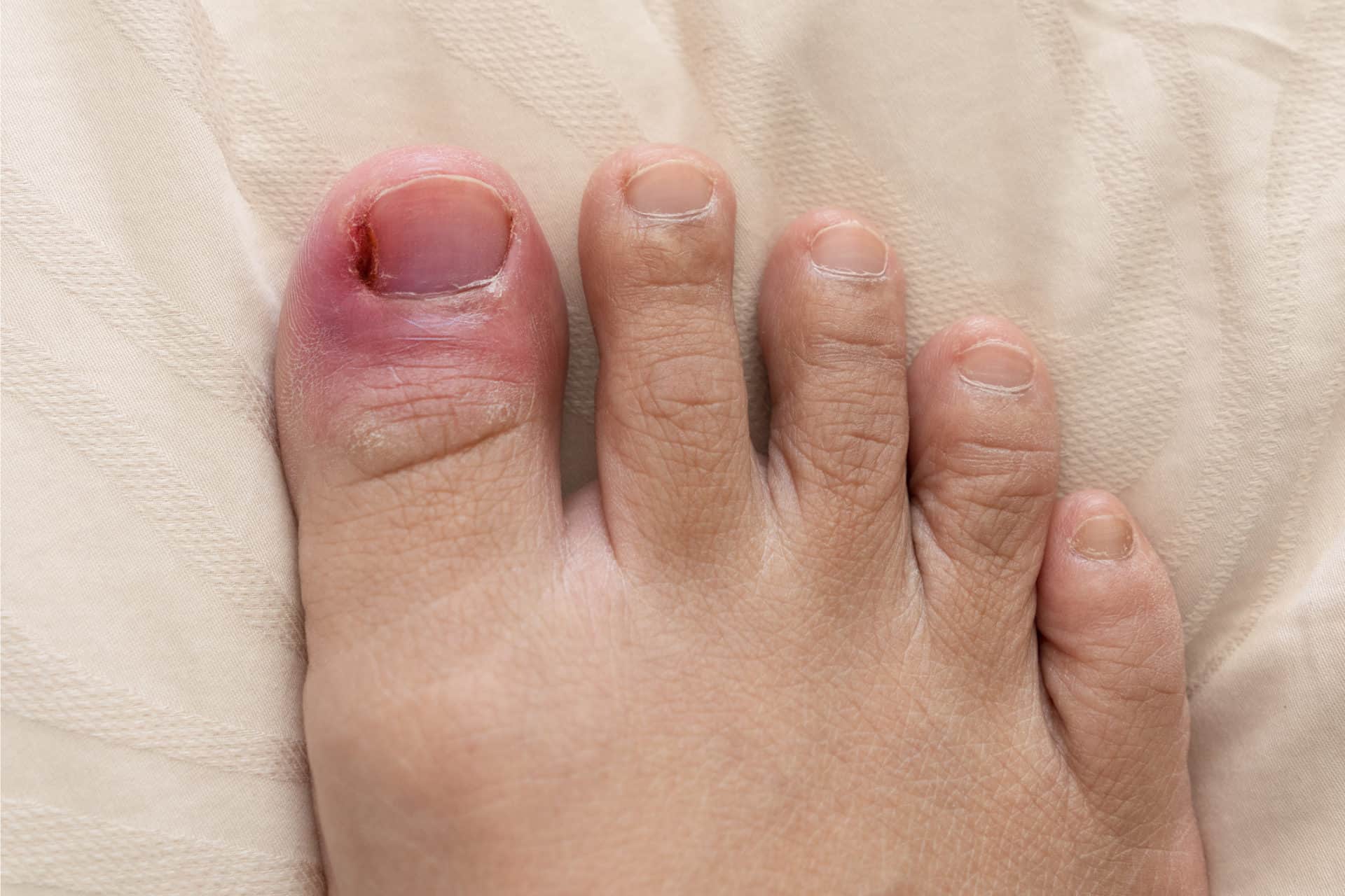Sore Great Toe