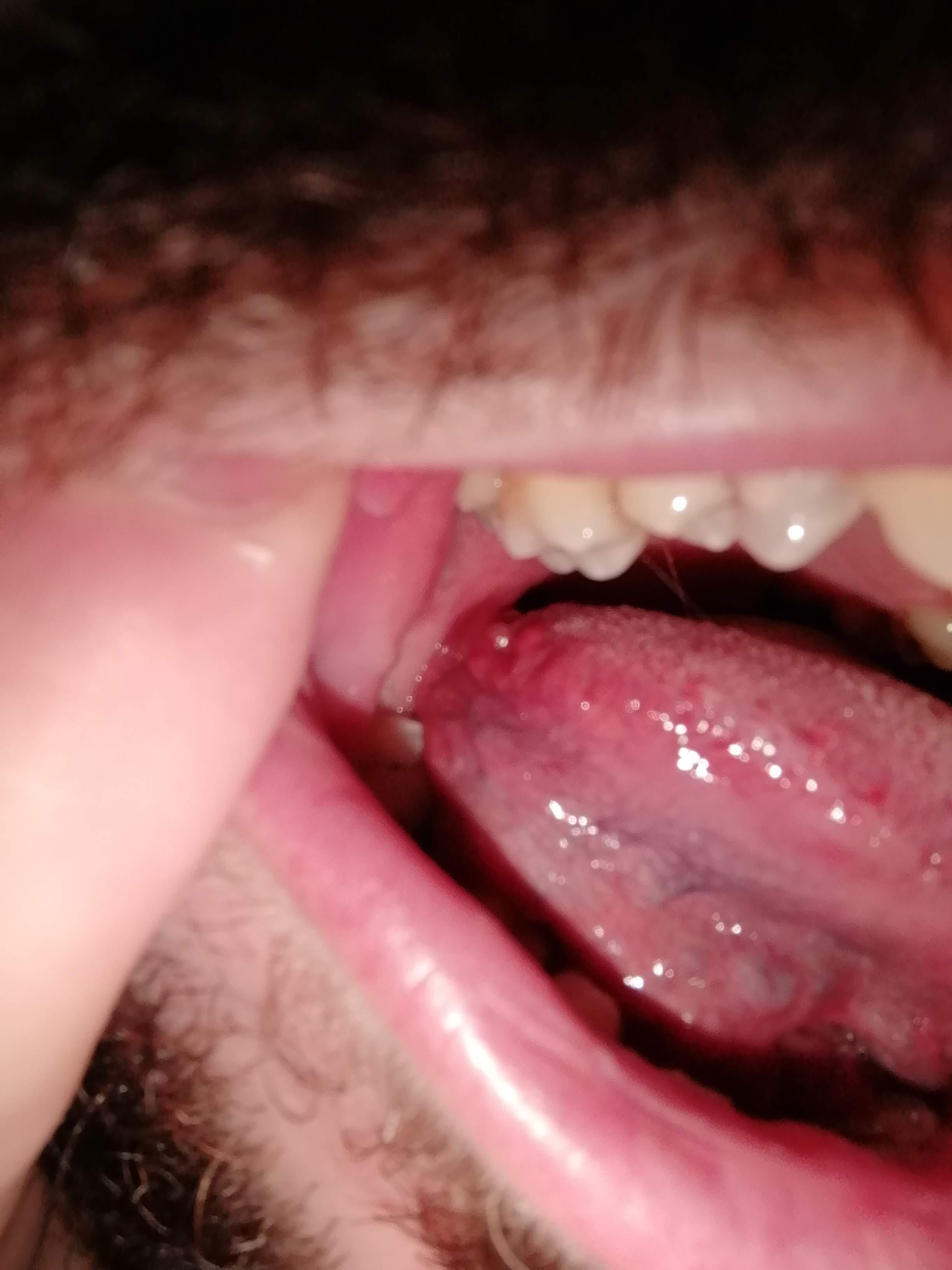 Sore On Side Of Tongue