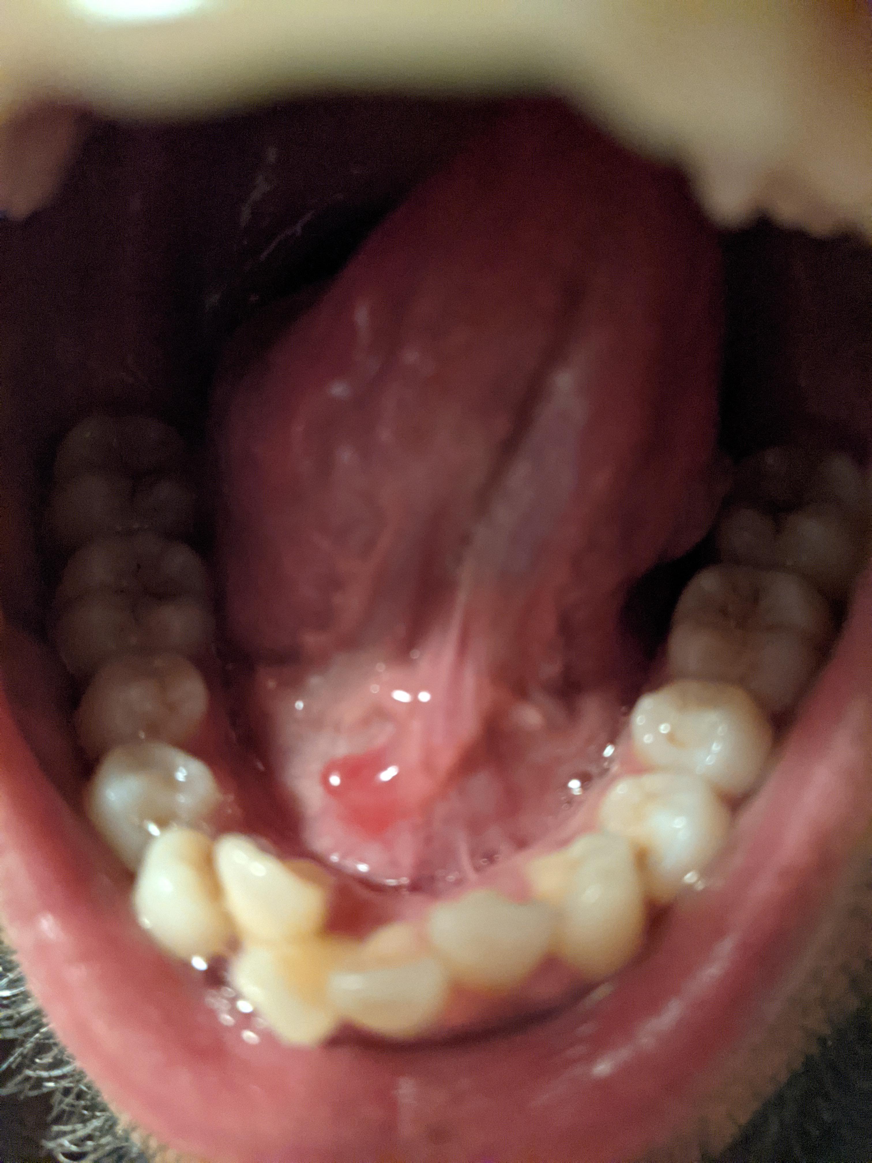 Sore Tongue Underside