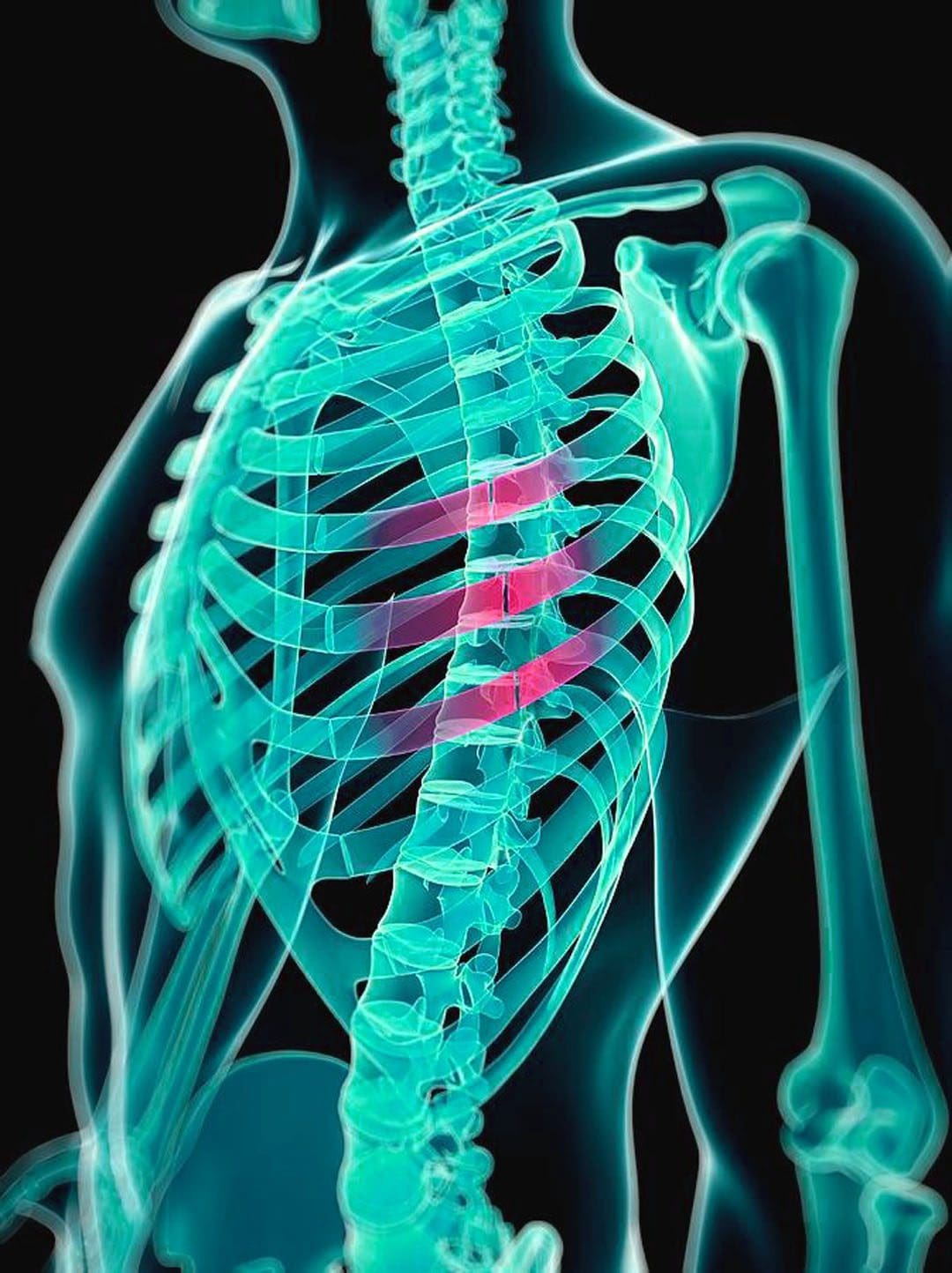 Soreness In Ribs From Coughing