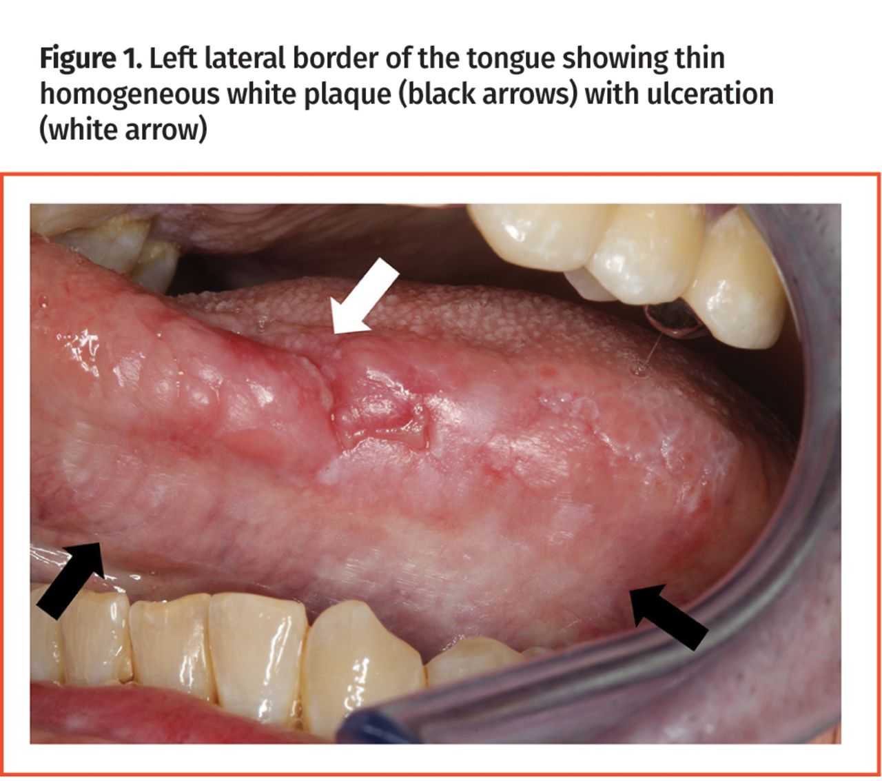 Sores In The Tongue Sides