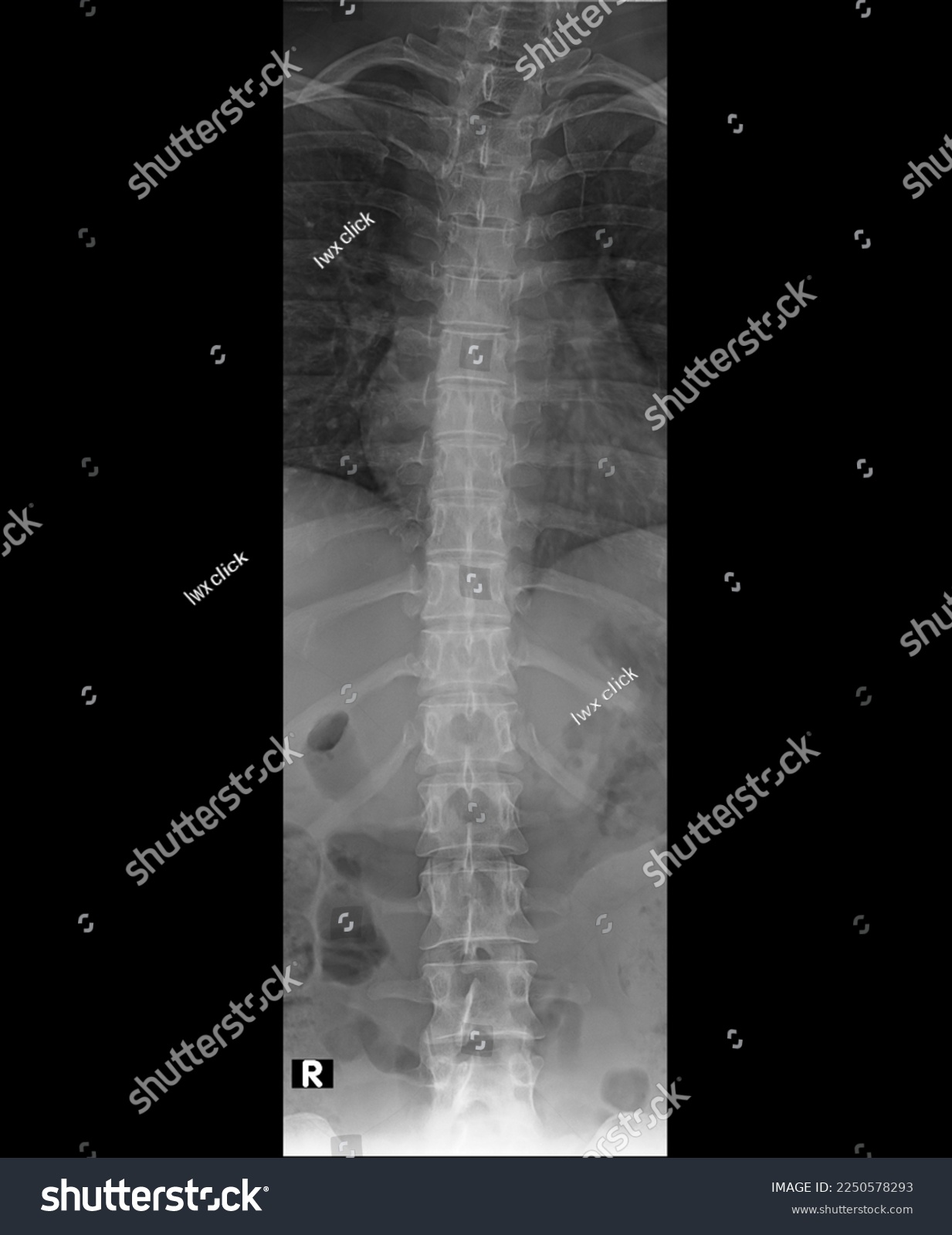 Spain X Ray