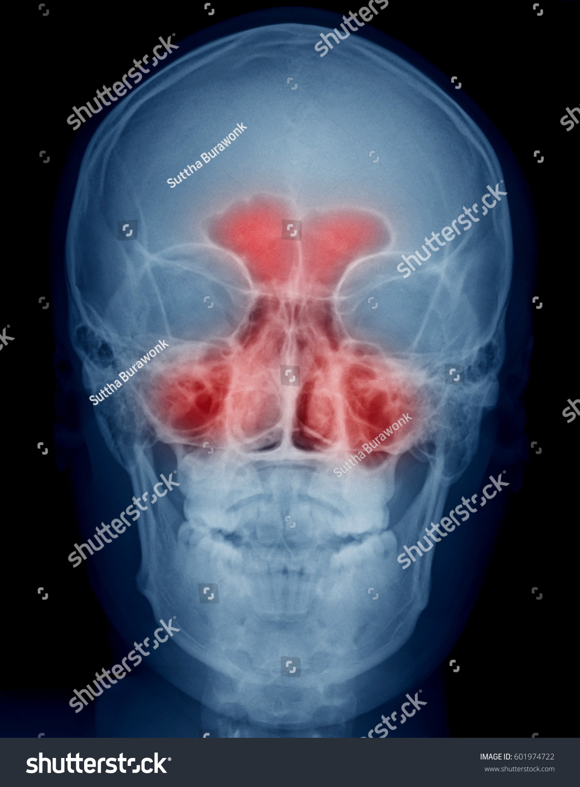 Sphenoid Sinus Infection