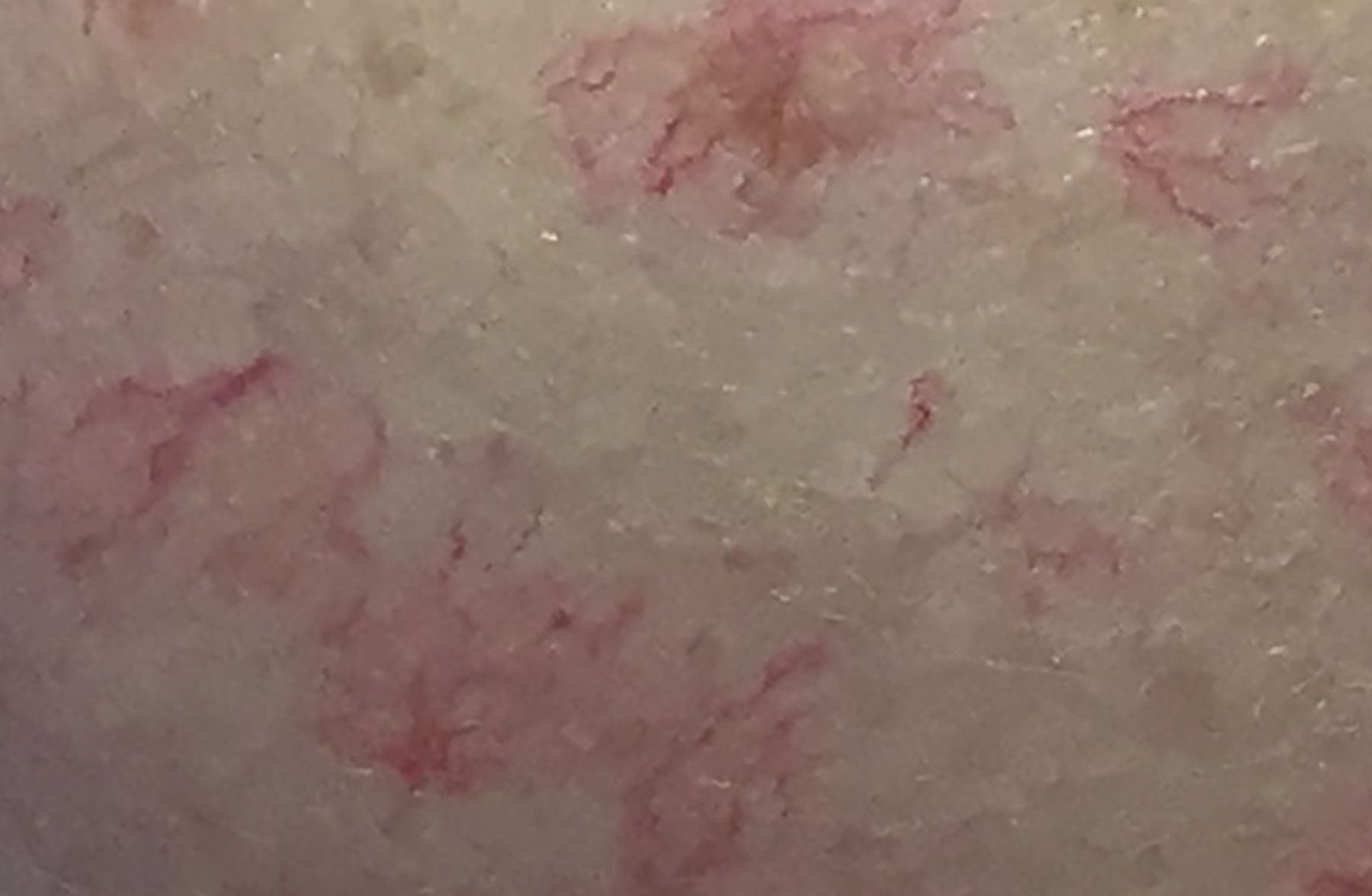 Spider Naevi In Cirrhosis