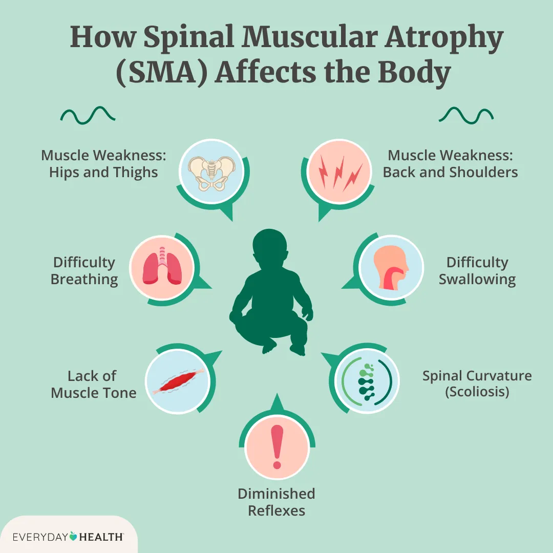 Spinal Muscular Atrophy Life Expectancy
