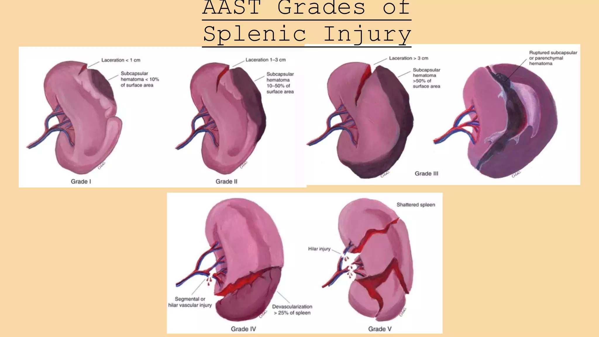 Splenic Laceration Grading