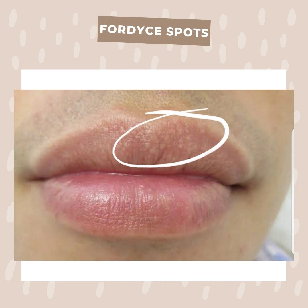 Spots On Lips Fordyce