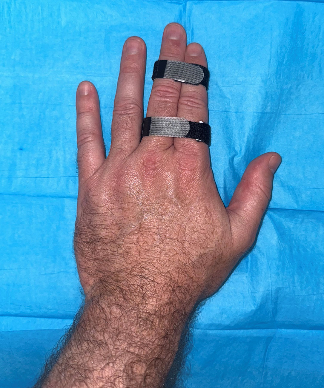 Sprain Finger Treatment