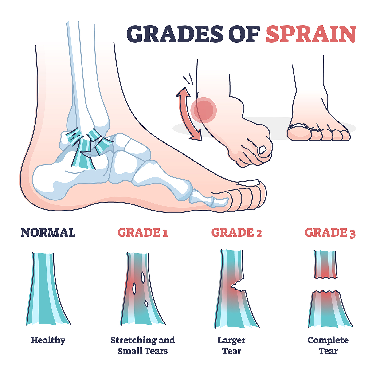 Sprain Levels Ankle