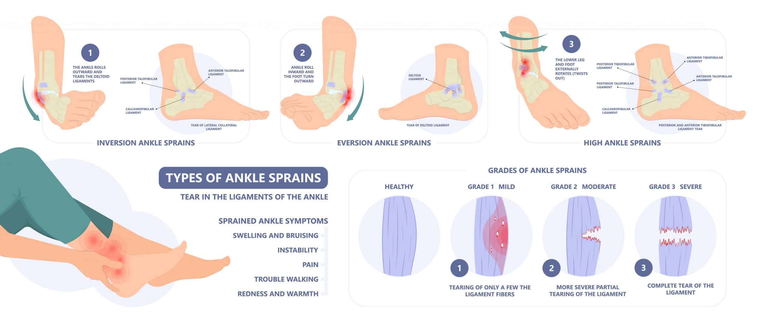 Sprained Ankle Signs