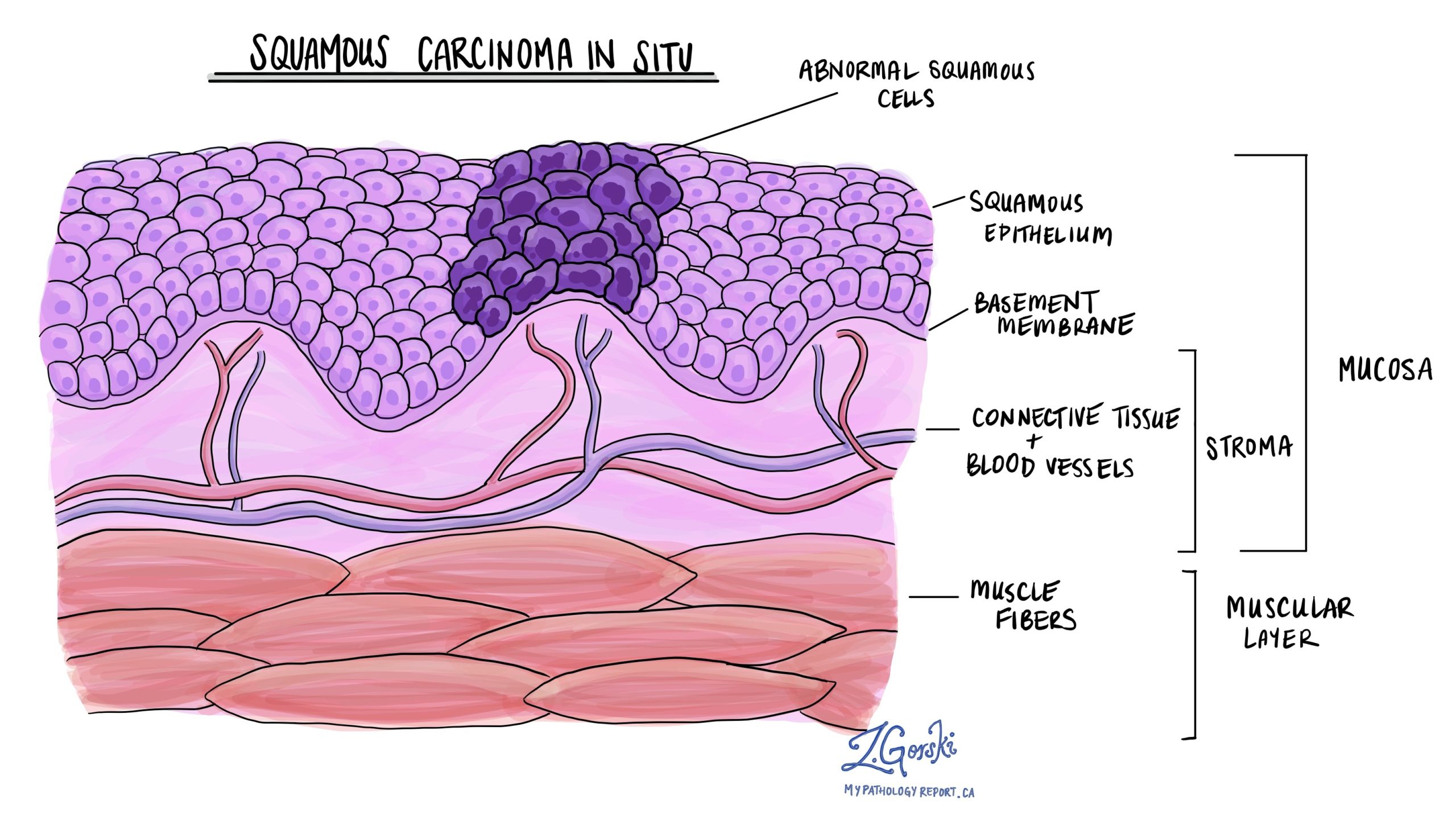 Squamous Cell Carcinoma In Situ