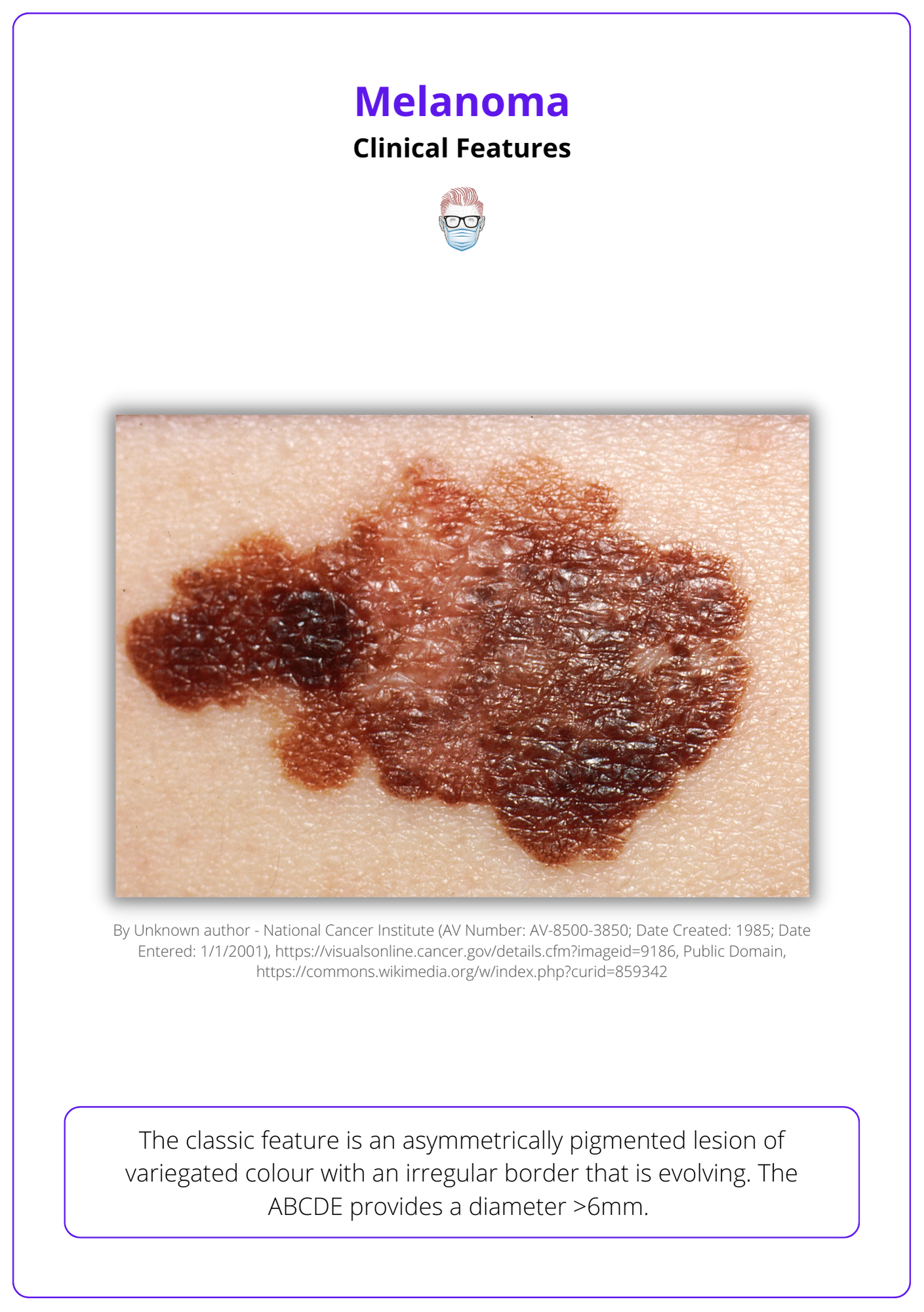 Stage 2 Melanoma