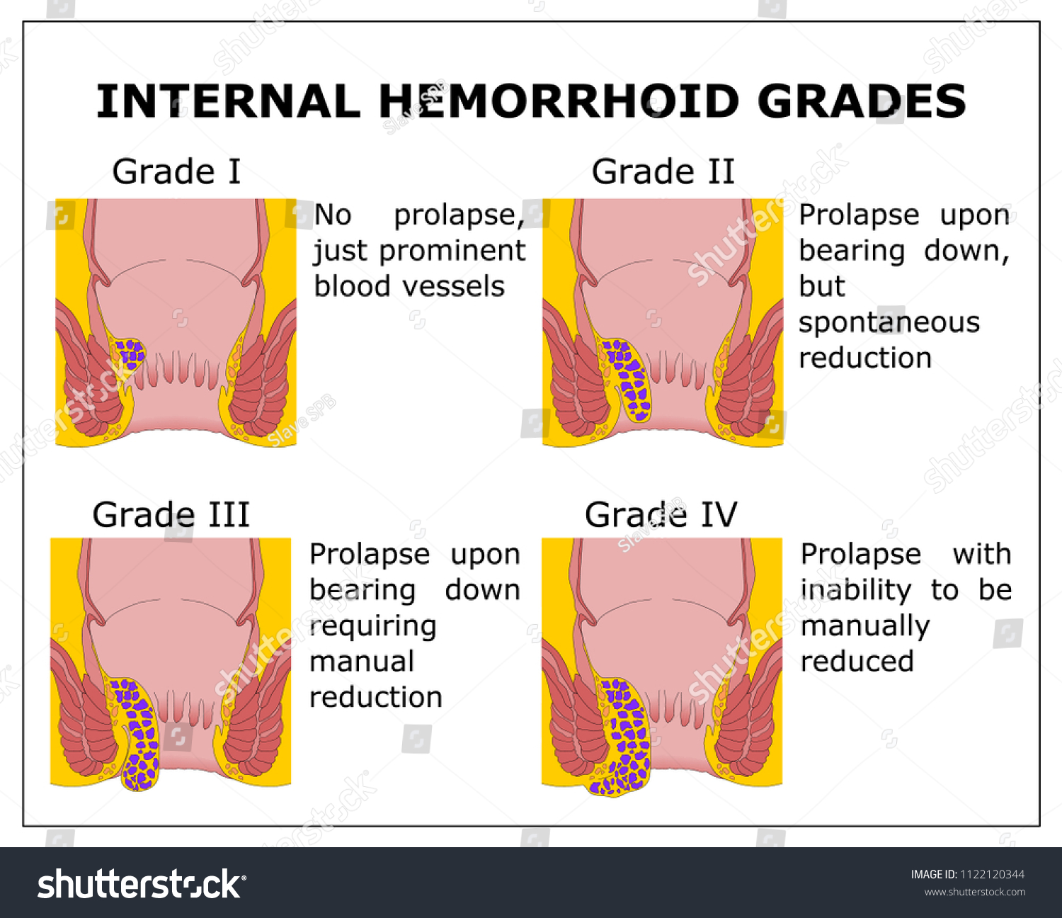 Stage Four Hemorrhoid