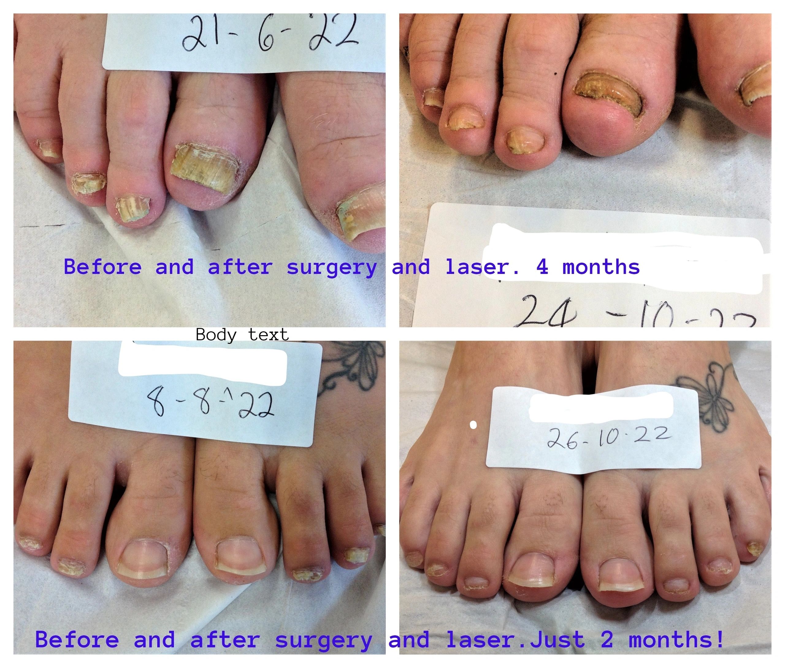 Stages Of Nail Growing Back