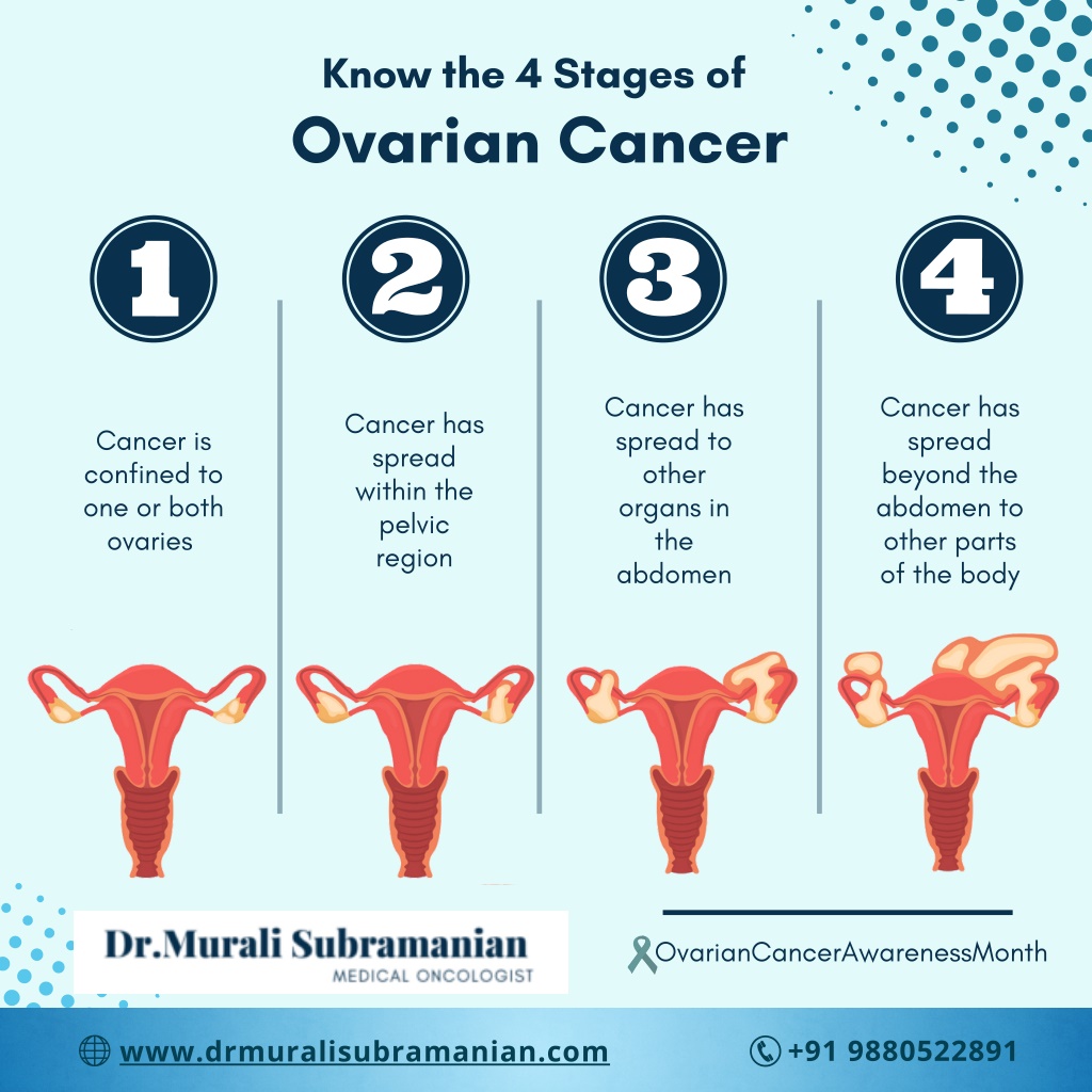 Stages Of Ovarian Cancer