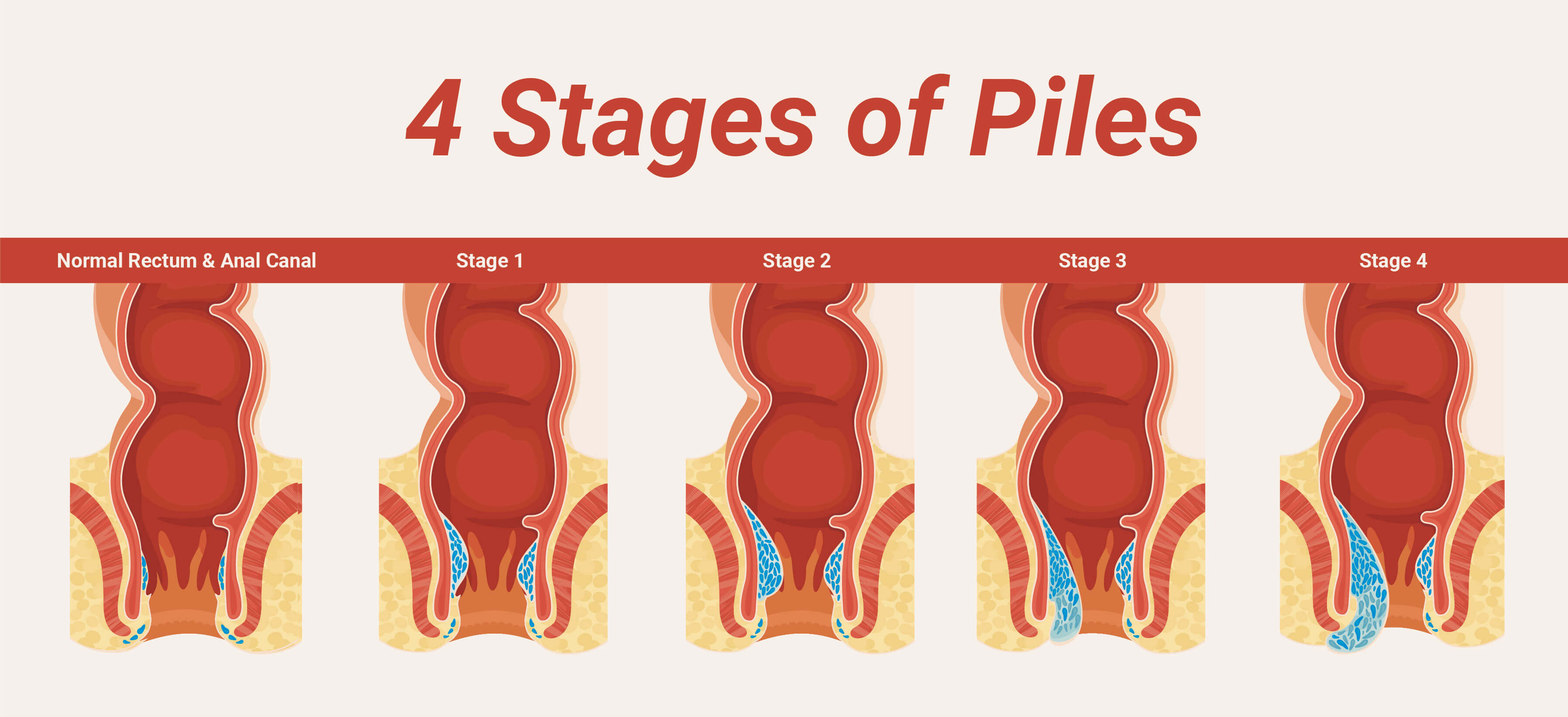 Stages Of Piles