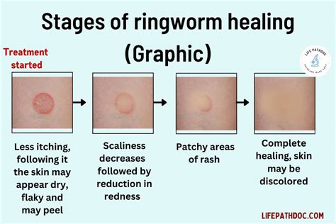 Stages Of Ringworm Healing