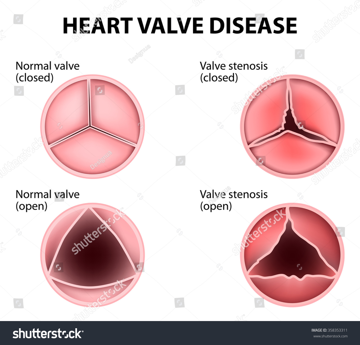 Stages Of Valvular Heart Disease