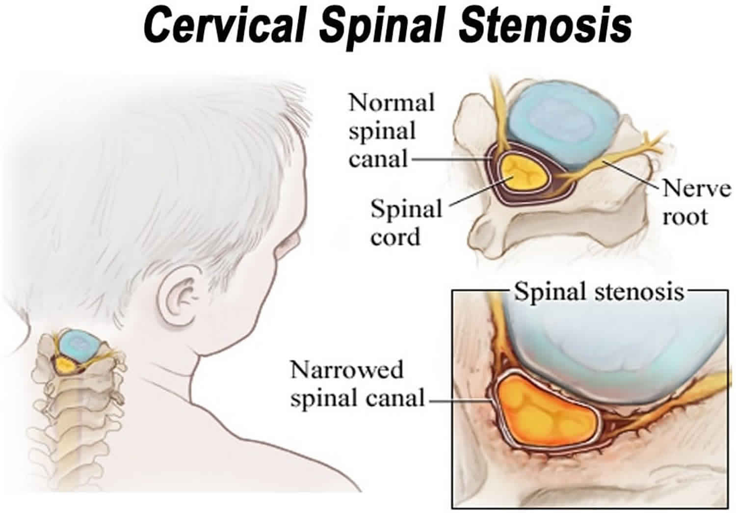 Stenosis Of The Neck