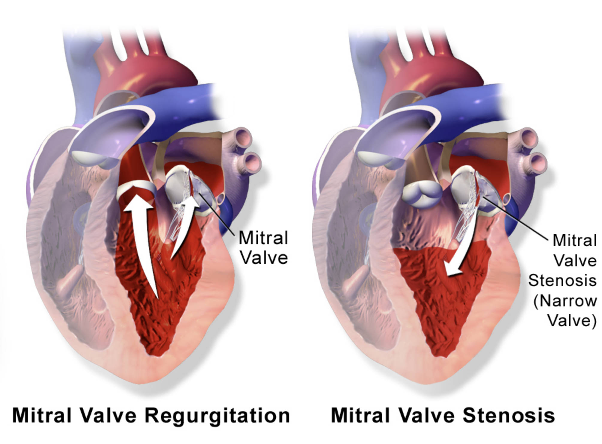 Stenosis Vs Regurgitation