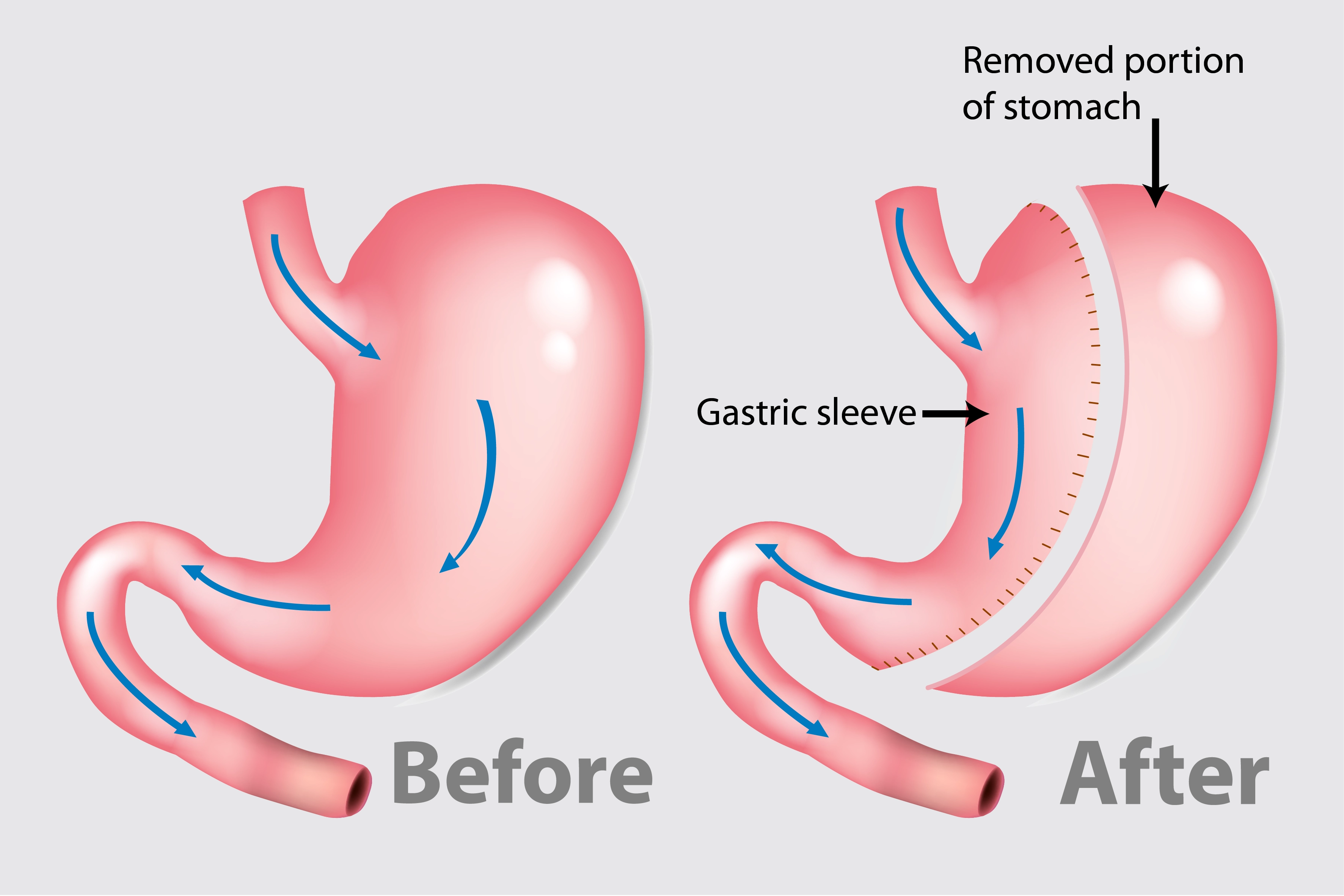 Stomach Removal Surgery
