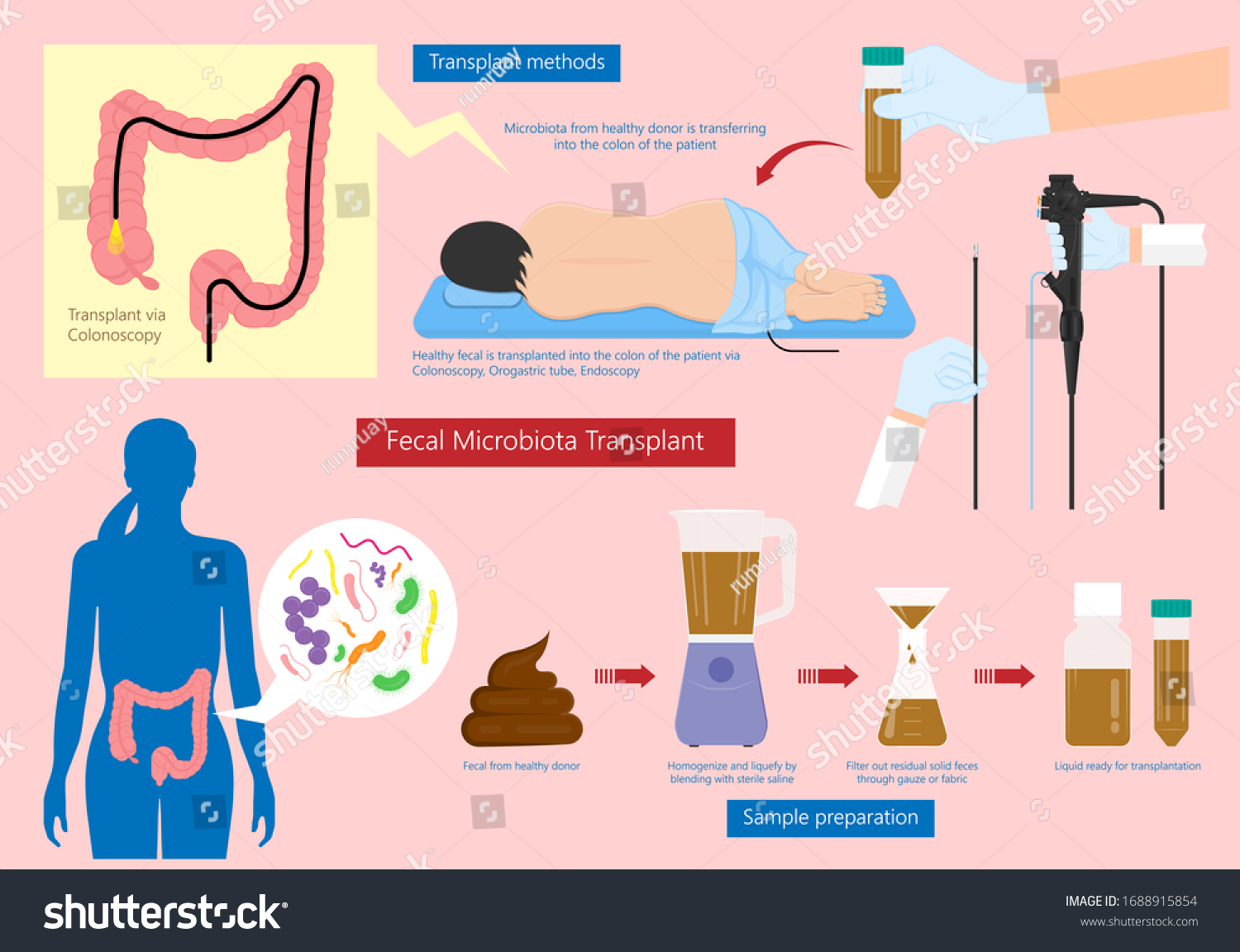 Stool Transfer For Clostridium Difficile