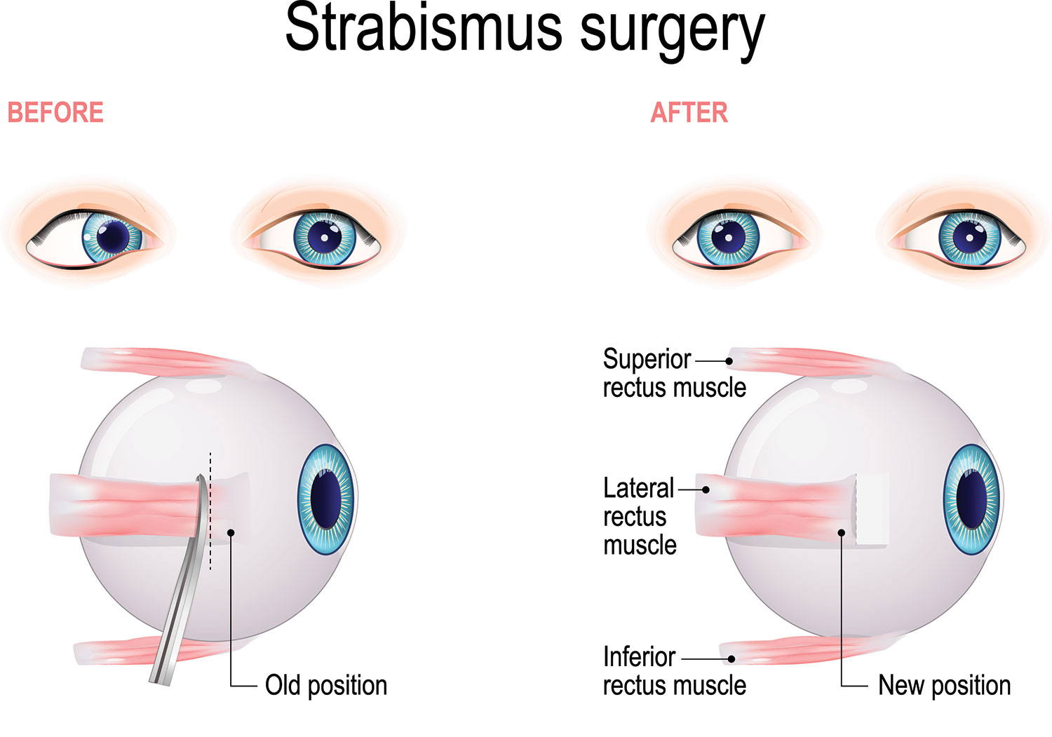 Strabismus Eye Treatment