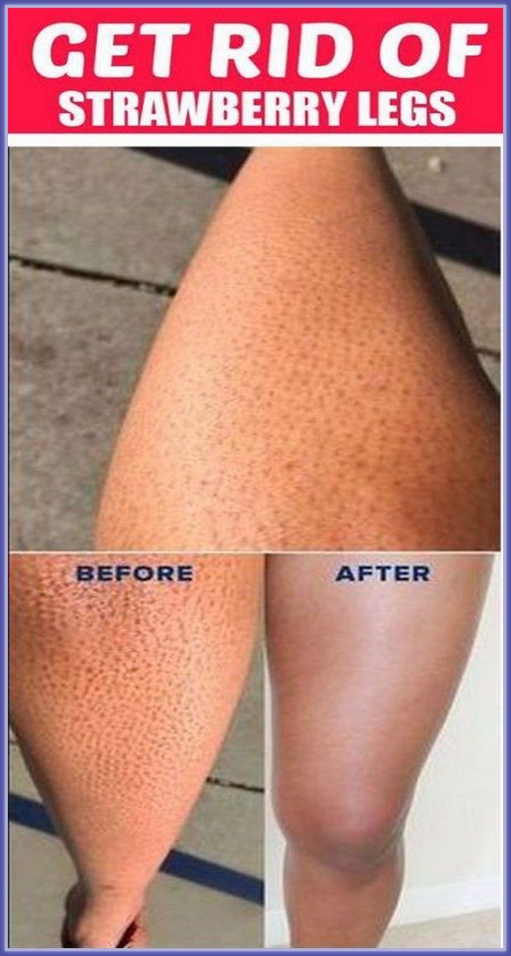 Strawberry Skin Legs