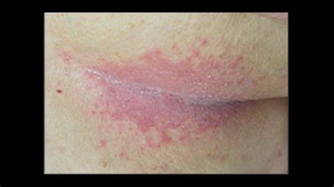 Strep Diaper Rash