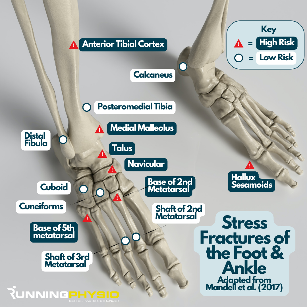 Stress Fracture Signs Symptoms