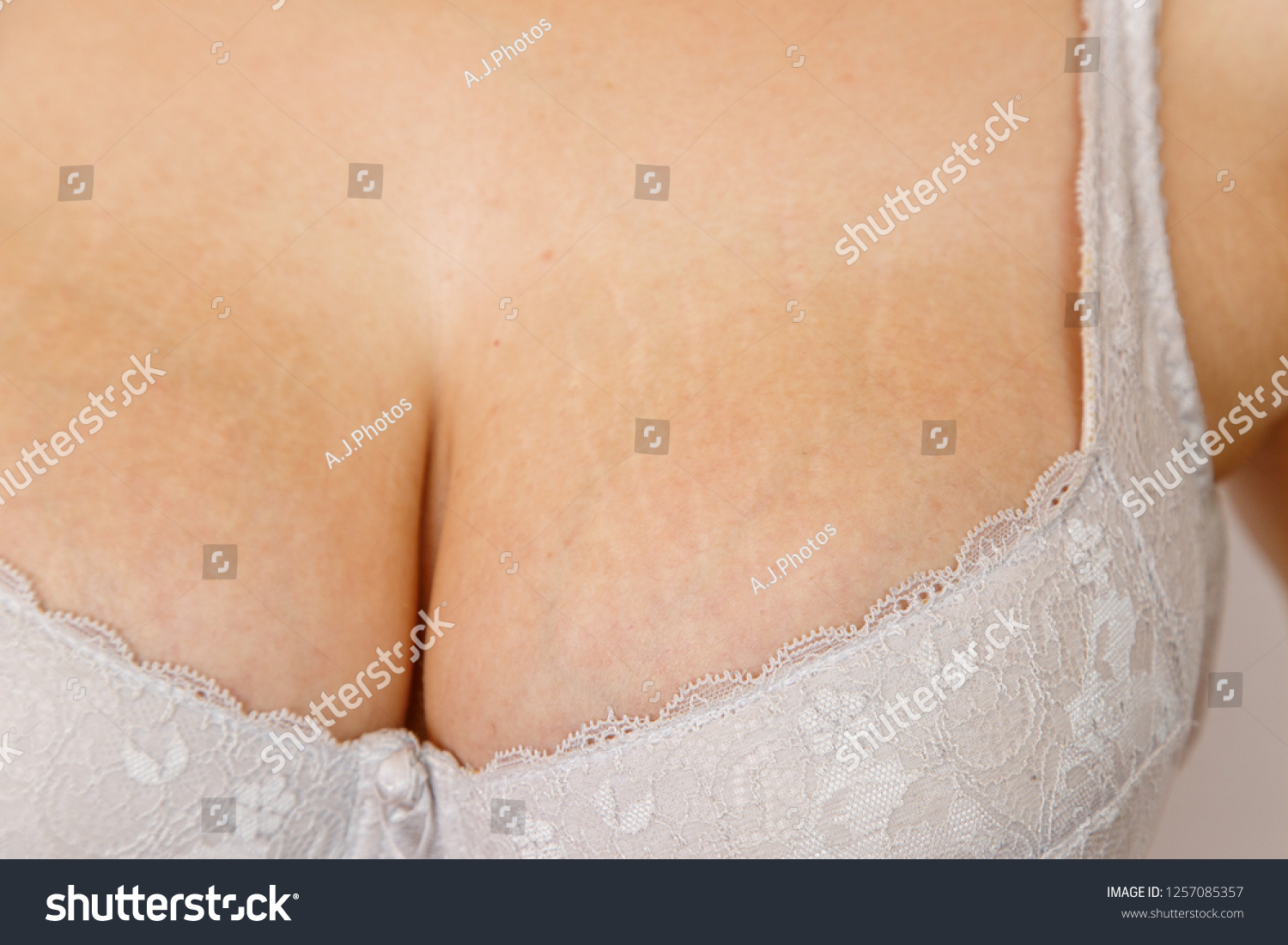 Stretch Marks On Breast
