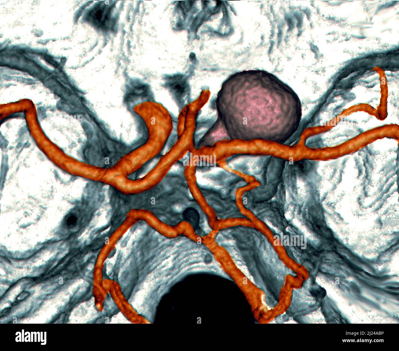 Subarachnoid Hemorrhage Ct