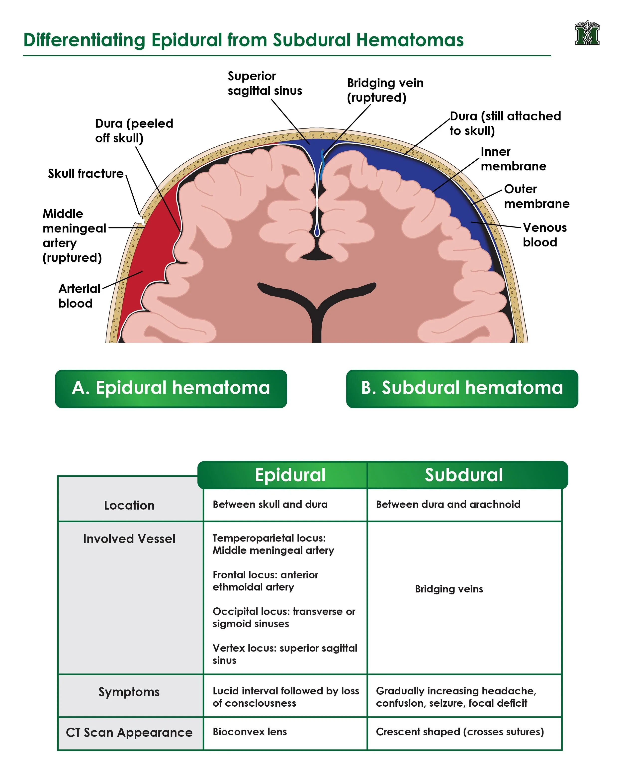 Subdural Hematoma Vs Epidural Hematoma