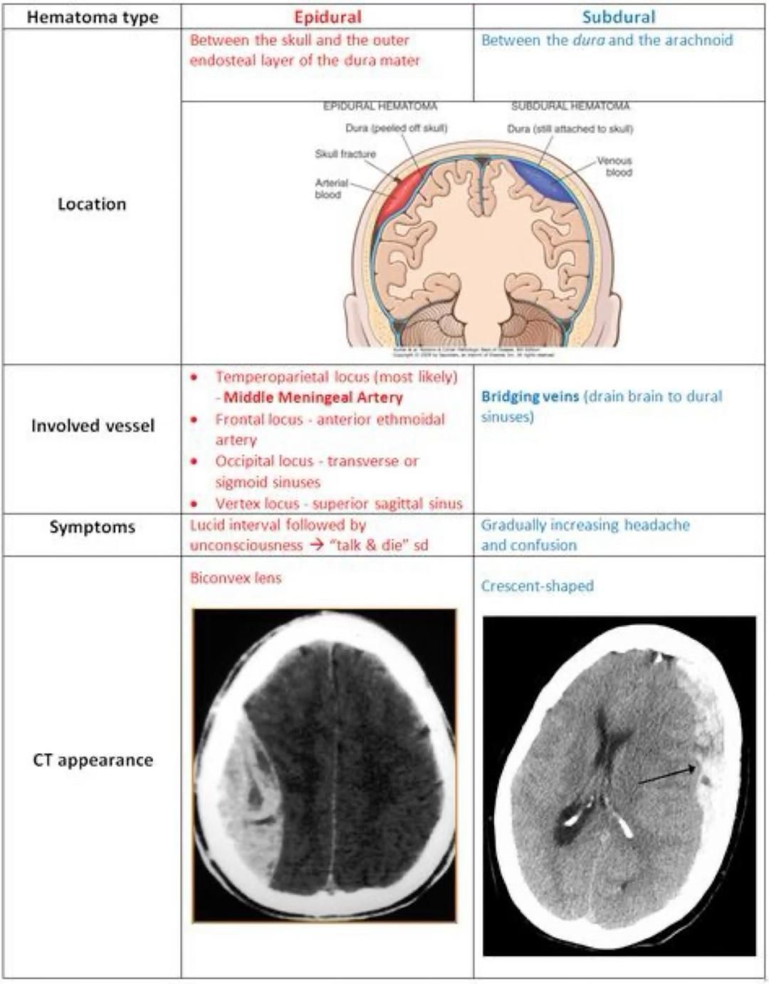 Subdural Vs Epidural Hematoma