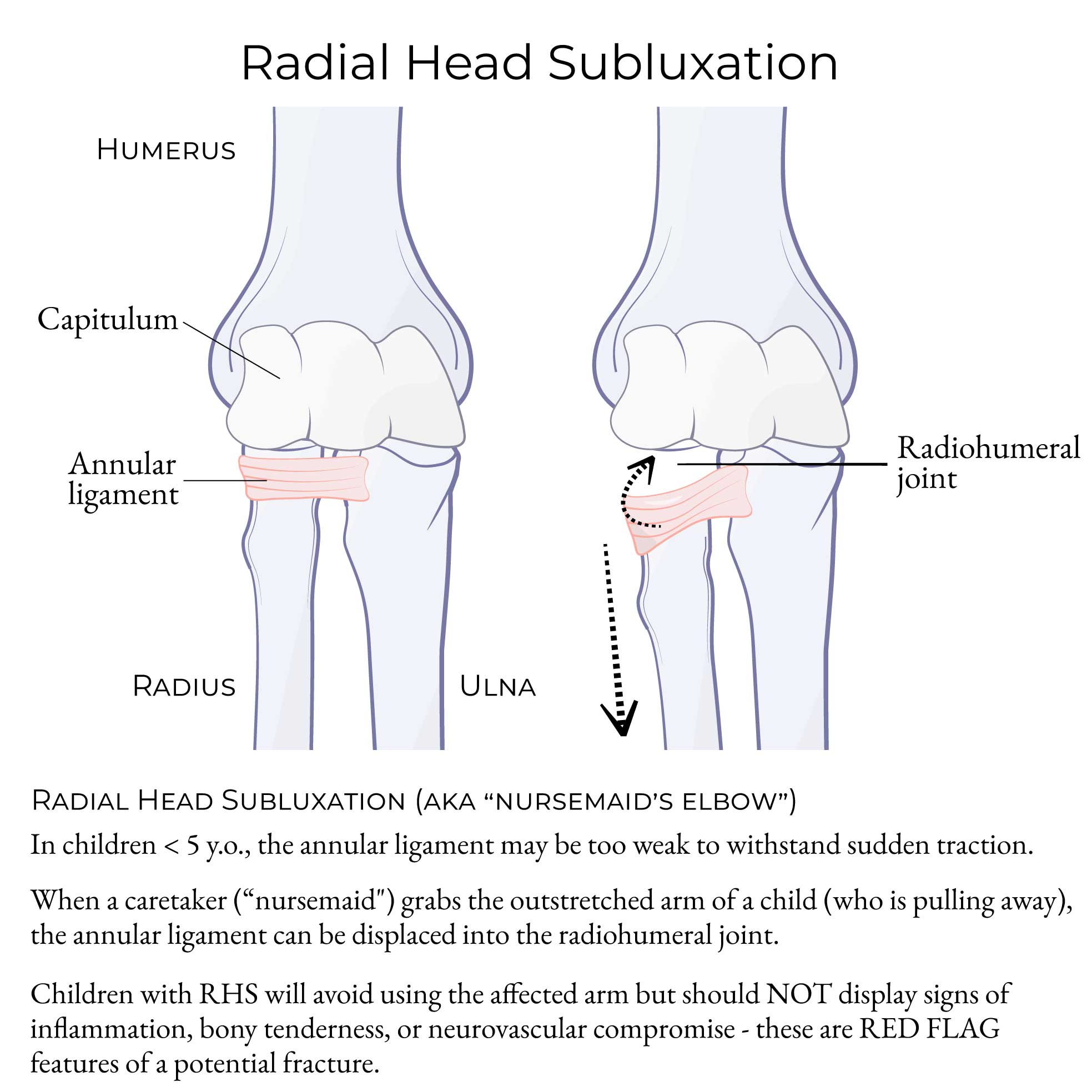 Subluxation Of Radius