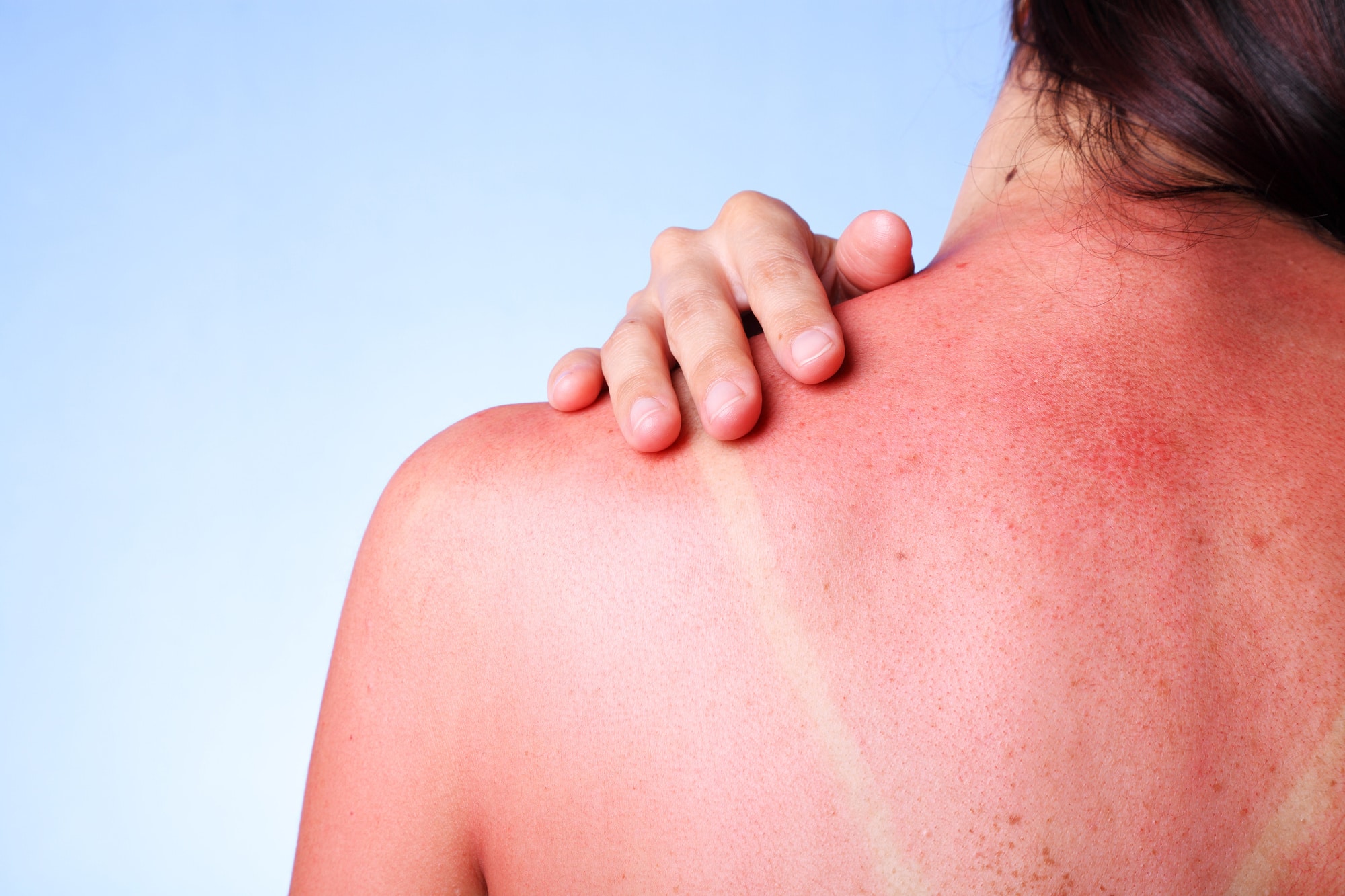 Sun Poison Symptoms