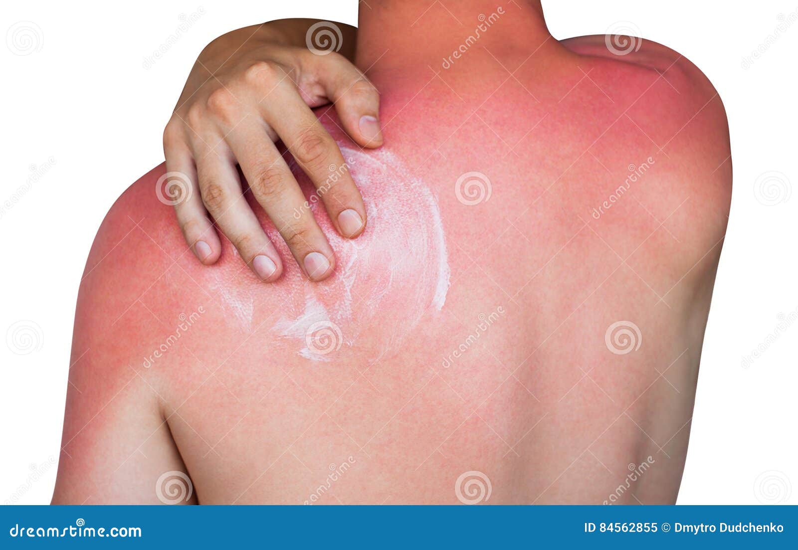 Sunburn Is Itching