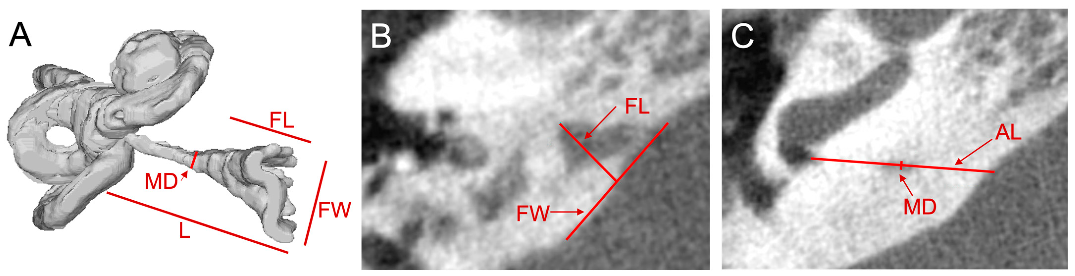 Superior Canal Dehiscence Syndrome