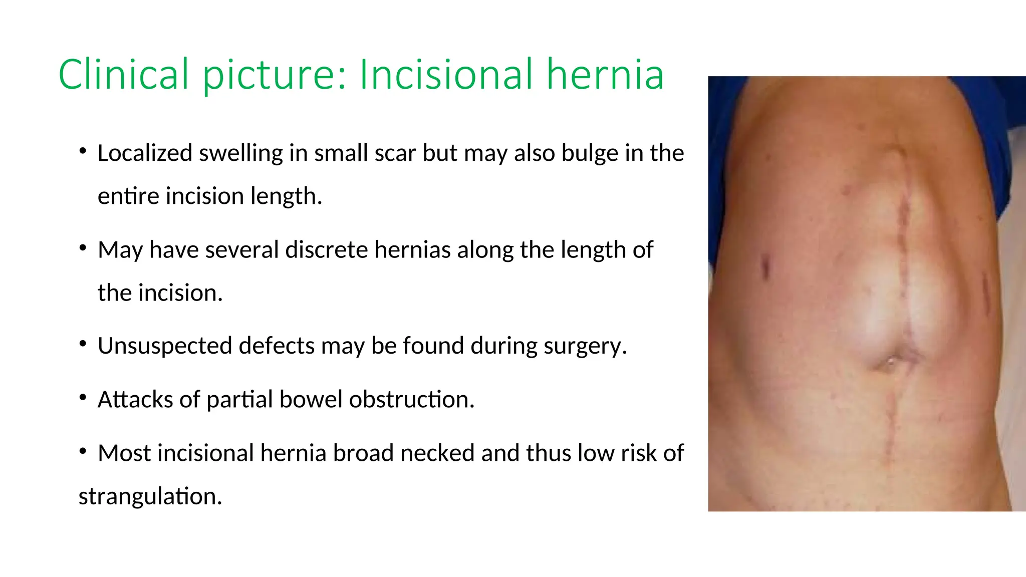 Surgery Abdominal Wall Hernia