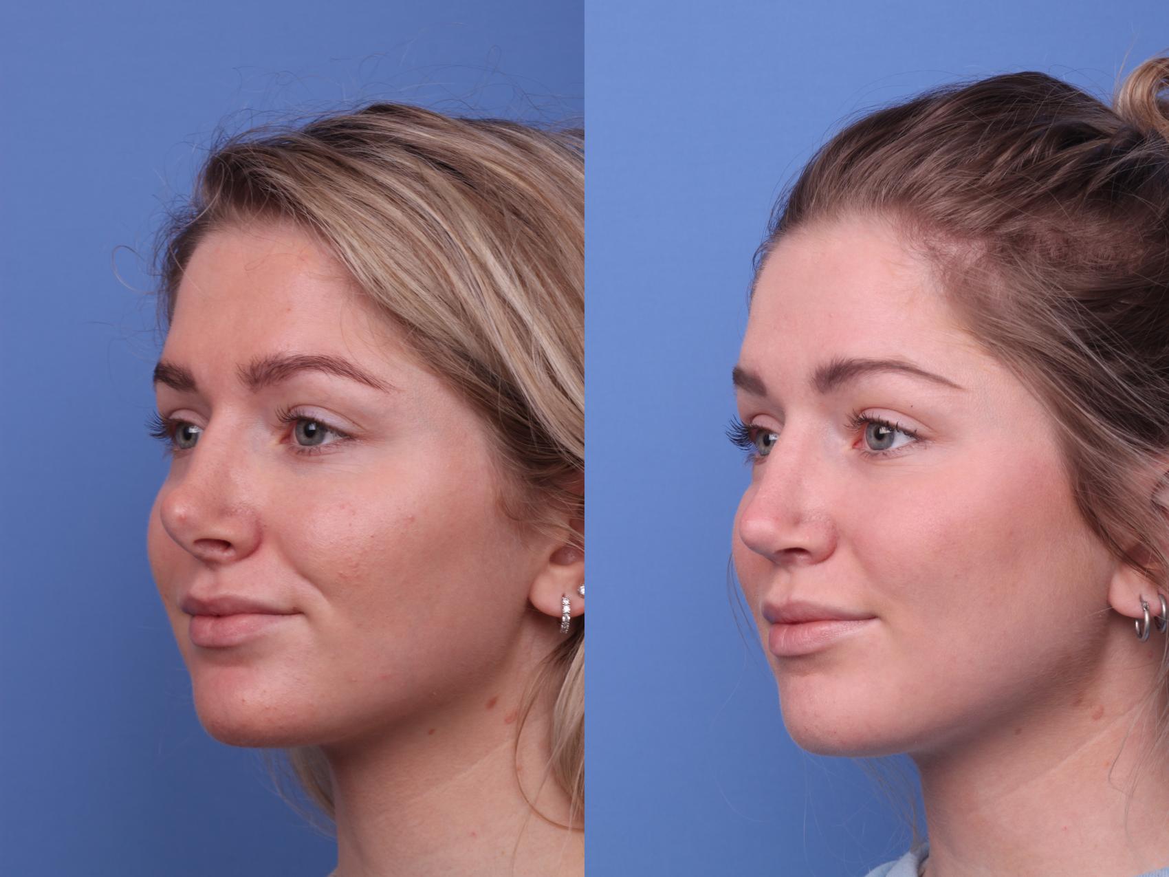 Surgery For Round Face