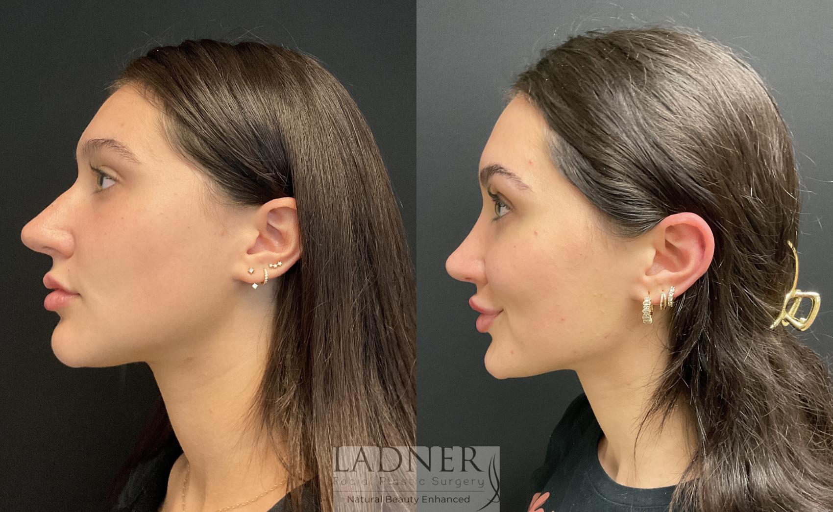 Surgery Nose Jobs