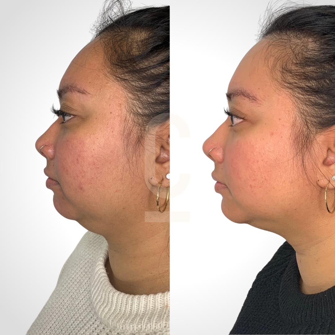 Surgery To Get Rid Of Face Fat