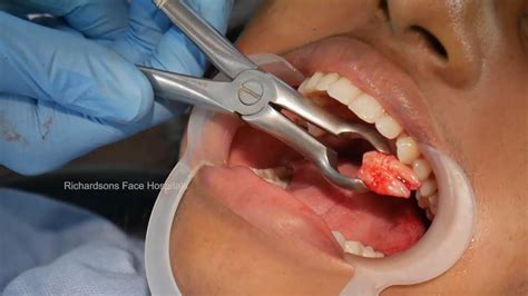 Surgical Removal Of Tooth