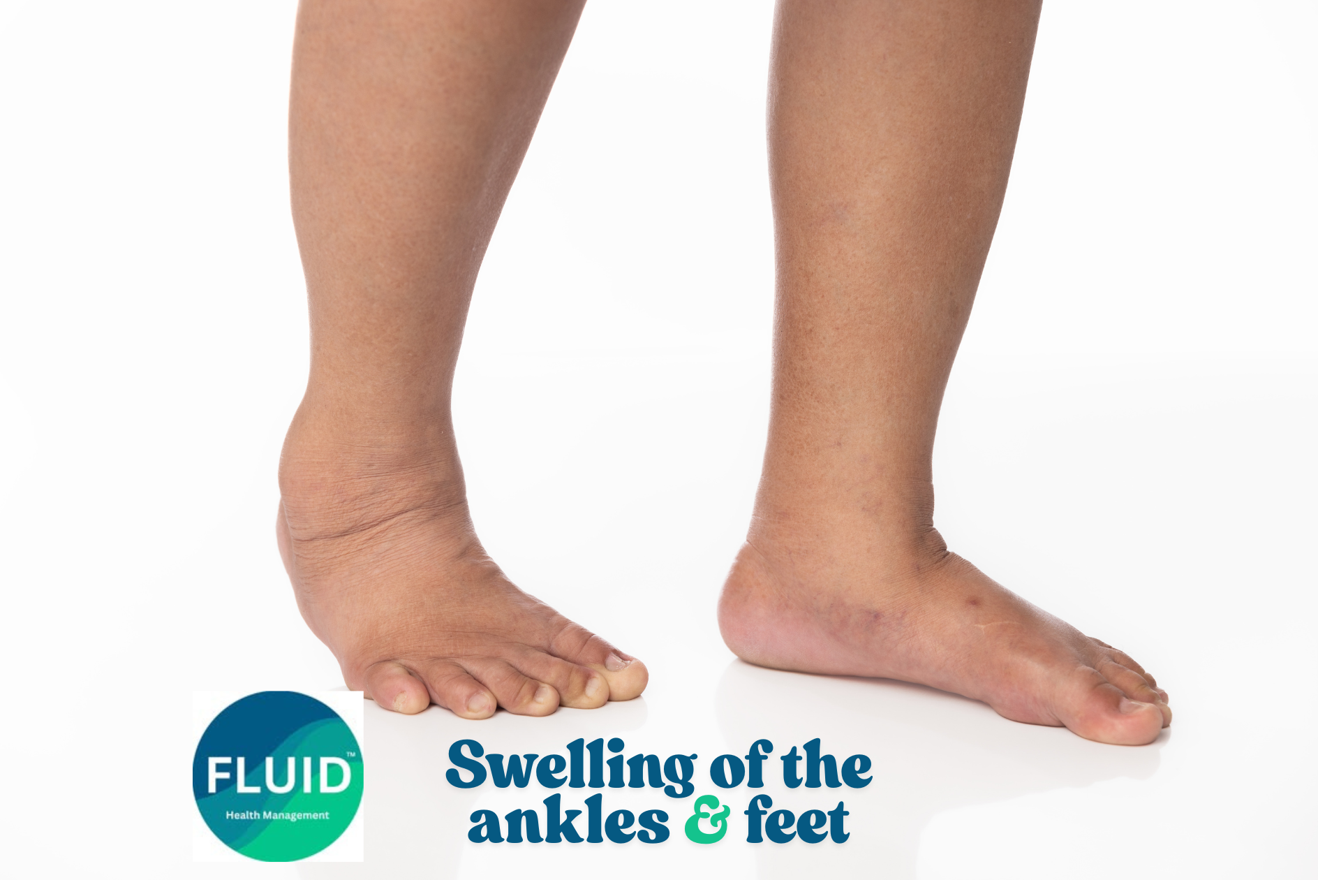 Swollen Ankles After Flight