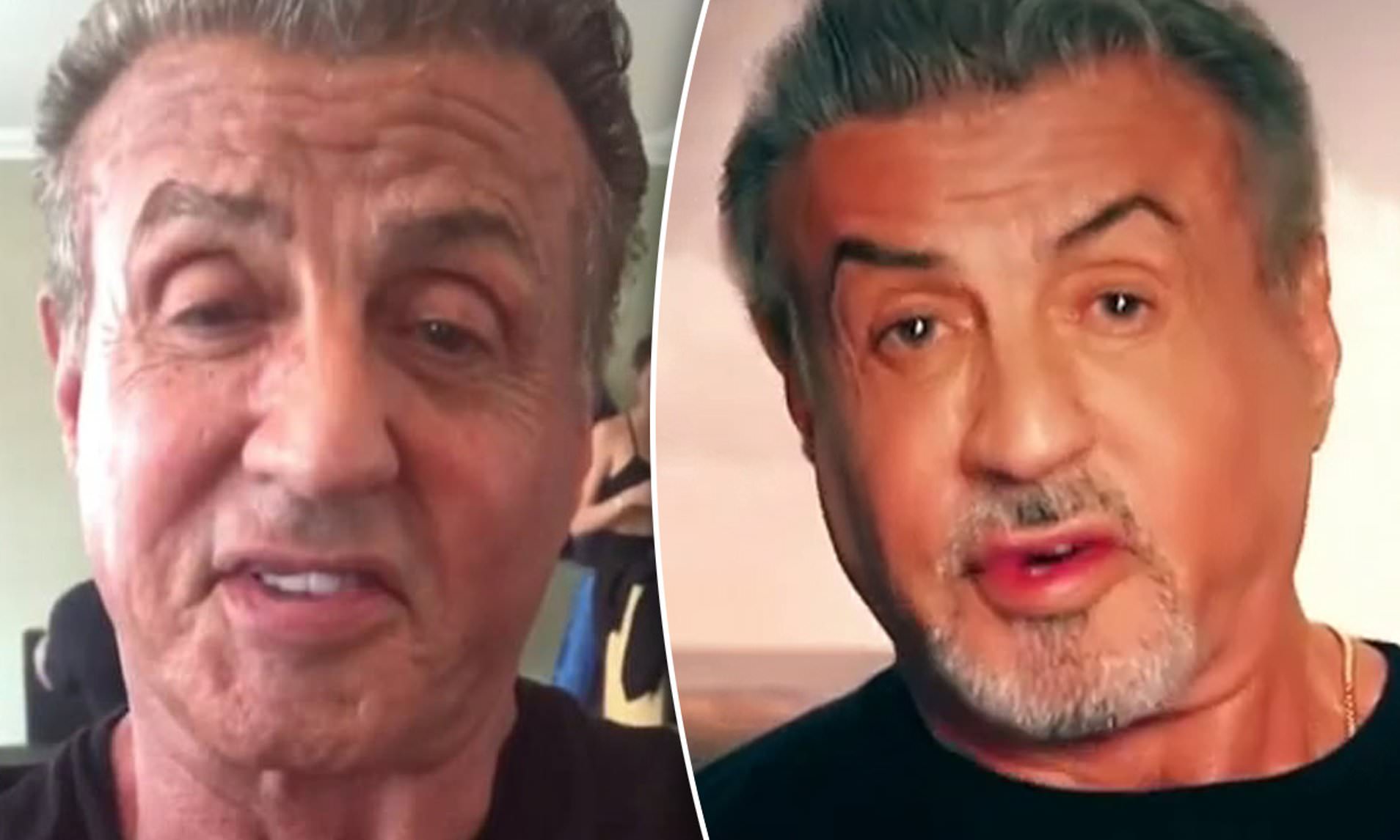 Sylvester Stallone Face Surgery